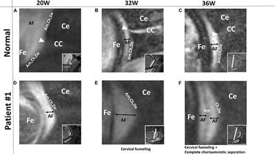 In vivo Assessment of Supra-Cervical Fetal Membrane by MRI 3D CISS: A Preliminary Study